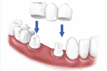 Crowns & Dental Bridges